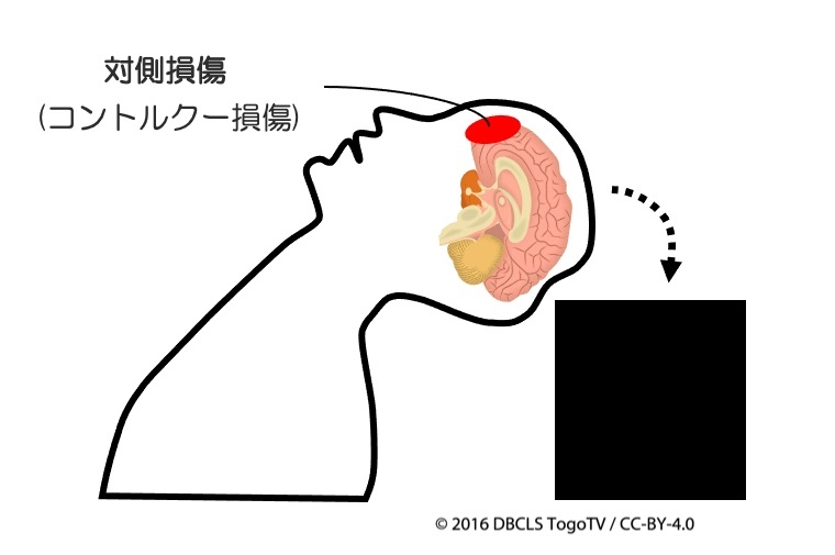 https://houigaku.blog/houigakublog/contrecoup-injury.jpg