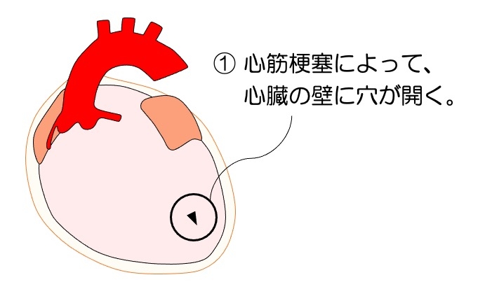 https://houigaku.blog/houigakublog/infarc-tamponade1.jpg