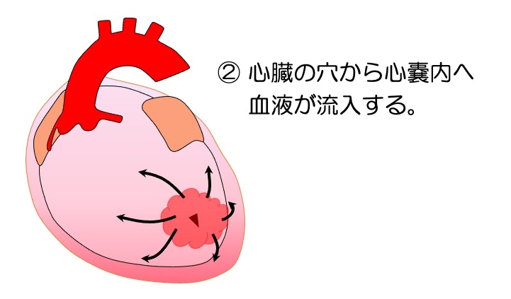 https://houigaku.blog/houigakublog/infarc-tamponade2.jpg