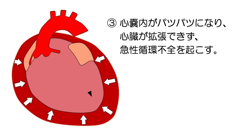 https://houigaku.blog/houigakublog/infarc-tamponade3.jpg