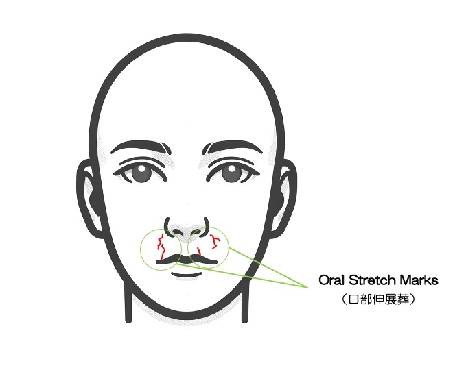 https://houigaku.blog/houigakublog/oral-stretch-marks.jpg