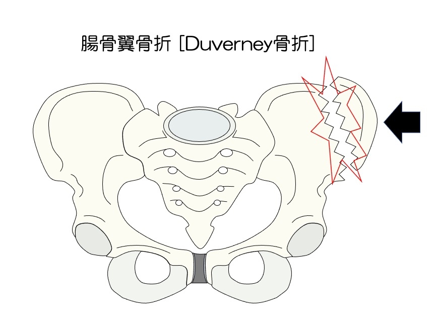 https://houigaku.blog/houigakublog/pelvic-fracture1.jpg