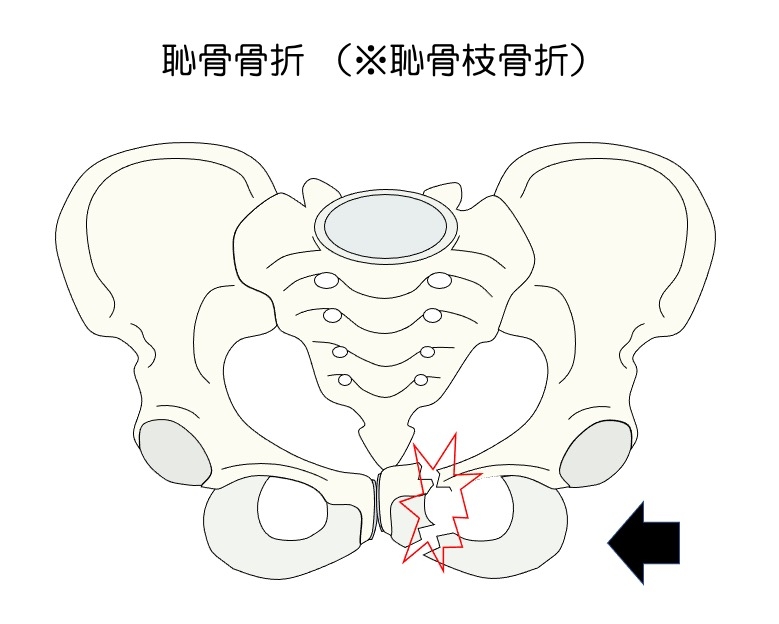 https://houigaku.blog/houigakublog/pelvic-fracture2.jpg