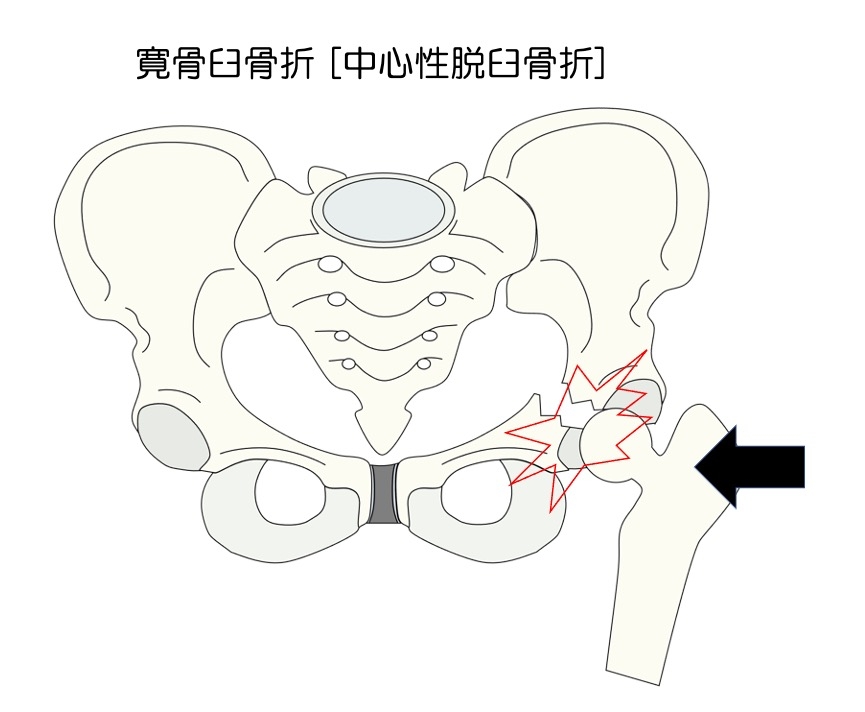 https://houigaku.blog/houigakublog/pelvic-fracture3.jpg