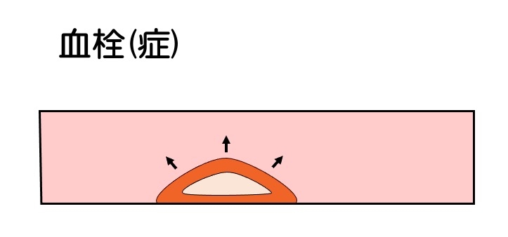 https://houigaku.blog/houigakublog/thrombosis.jpg